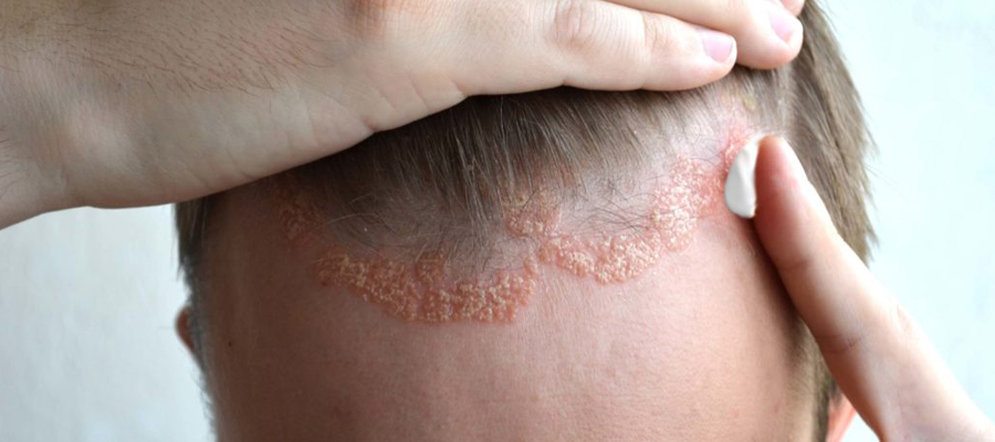 psoriasis cheveux traitements